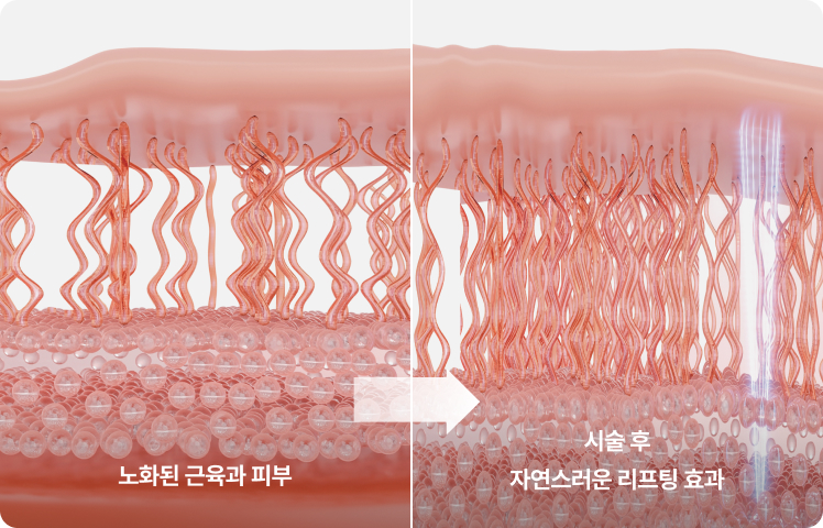 노화된 근육과 피부, 시술 후 자연스러운 리프팅 효과